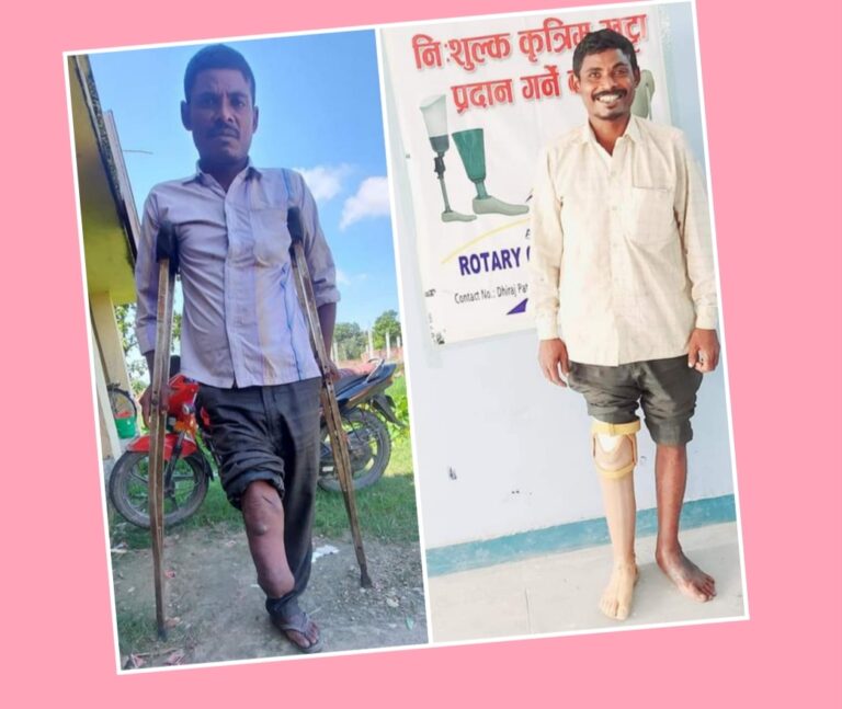 कृतिम खुट्टा पाएपछि जीवन कै धेरै खुशी