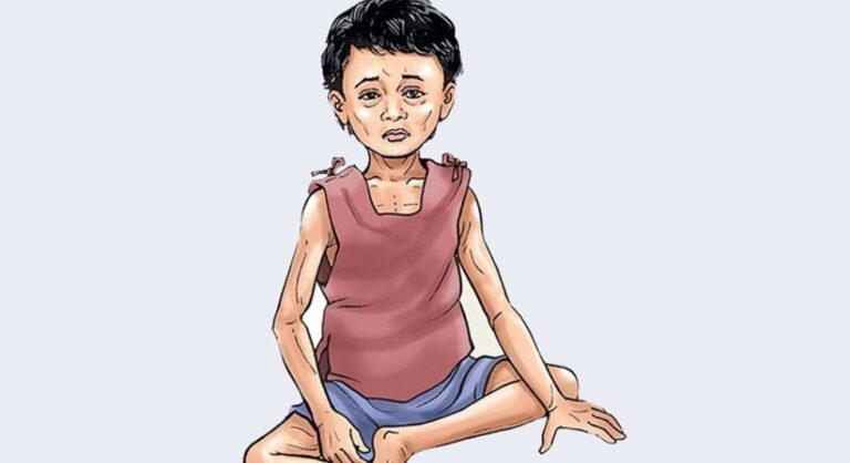 कुपोषणको जोखिममा रौतहटका वालवालिका